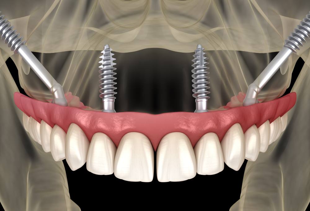 Схема имплантации зубов