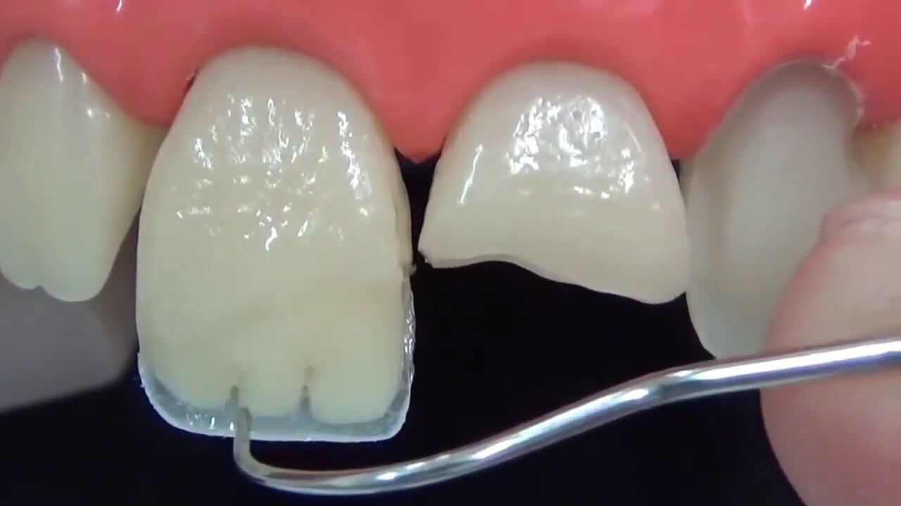 Изменение формы и размера зуба