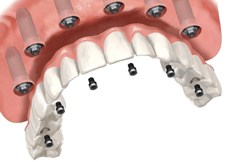 Несъемный зубной протез на 4 имплантах цена