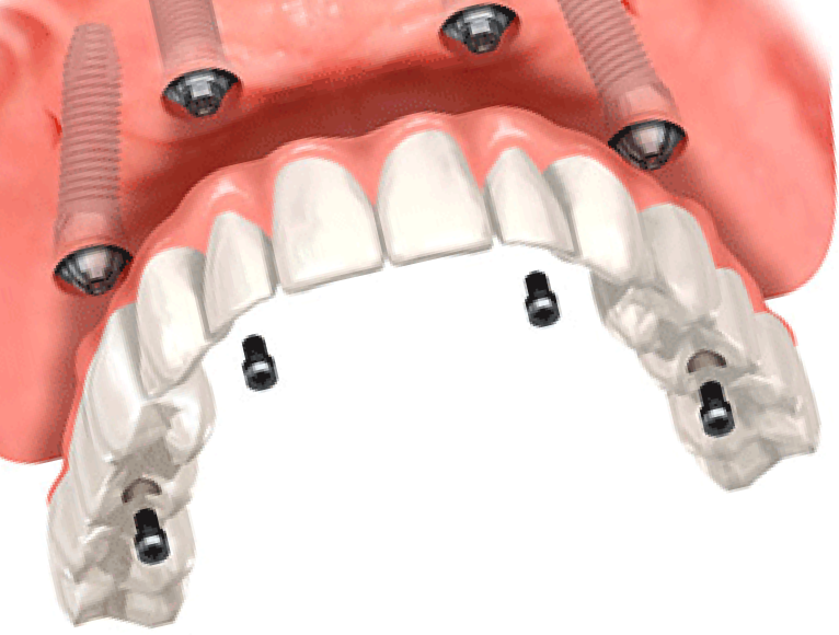 Все На 6 Имплантах Цена Под Ключ