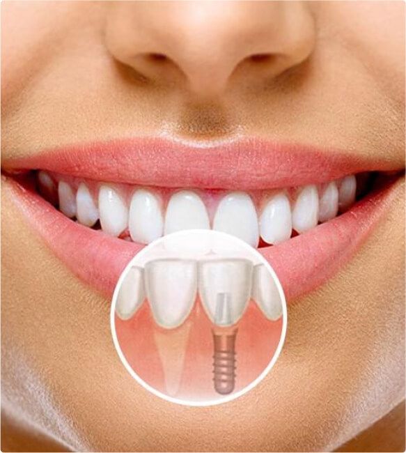 Импланты ничем не отличаются от обычных зубов