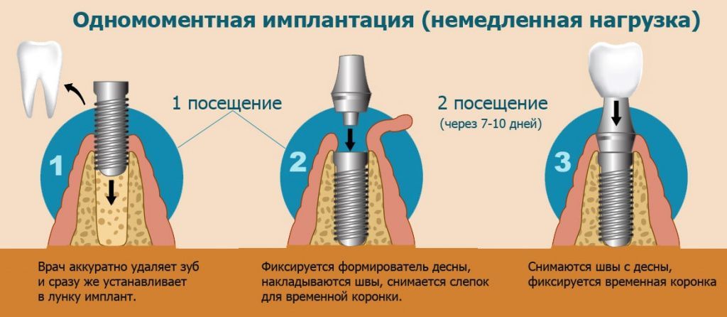 Возможно ли на один имплант установить две коронки, так как отсутствуют два соседних зуба?