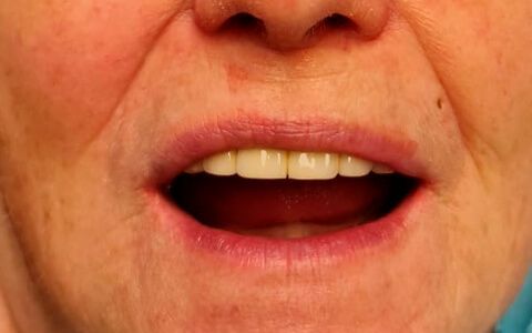 В восстановлении зубов нуждалась нижняя челюсть