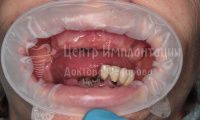 Восстановление зубов на верхней и нижней челюстях - Фотография 1