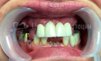 Восстановление зубов - Фотография 4