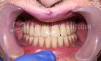 Восстановление зубов на верхней и нижней челюсти - Фотография 4
