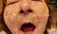 Имплантация всех зубов при полной адентии - Фотография 1