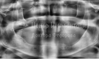 Восстановление зубов на верхней челюсти - Фотография 3