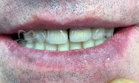 Восстановление зубов на нижней челюсти - Фотография 2