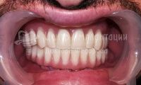 Восстановление зубов на нижней челюсти - Фотография 4