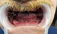 Полное восстановление всех зубов - Фотография 3