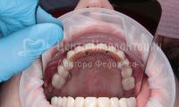 Восстановление зубов на верхней и нижней челюстях - Фотография 3