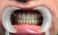 Восстановление зубов на двух челюстях - Фотография 2