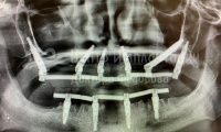 Имплантация зубов - Фотография 4