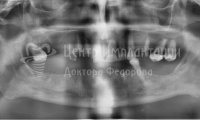 Восстановление зубов на двух челюстях - Фотография 3