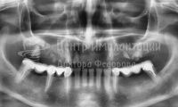 Восстановление зубов на верхней челюсти - Фотография 1