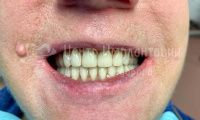 Имплантация зубов 