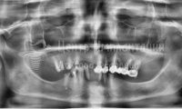 Восстановление зубов на верхней и нижней челюсти - Фотография 3