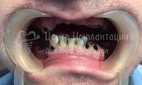 Восстановление зубов на обеих челюстях - Фотография 1