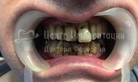 Восстановление зубов на двух челюстях при парадонтозе - Фотография 1