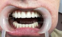 Восстановление зубов на обеих челюстях при парадонтозе - Фотография 4