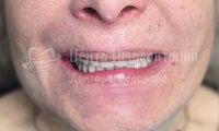 Имплантация на верхней и нижней челюсти - Фотография 1