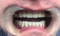 Восстановление зубов на обеих челюстях - Фотография 2