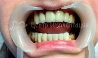 Имплантация зубов - Фотография 3