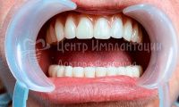 Имплантация зубов - Фотография 2