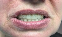 Восстановление зубов на верхней и нижней челюсти - Фотография 2
