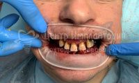 Восстановление обоих зубных рядов - Фотография 2