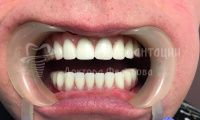 Восстановление зубов на обеих челюстях при пародонтозе - Фотография 2