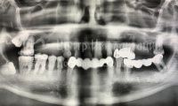 Восстановление обоих зубных рядов - Фотография 3