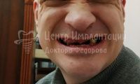 Множественный кариес зубов - Фотография 2