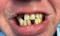 Полное восстановление зубов по протоколу «All-on-6» - Фотография 1