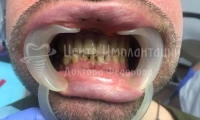 Восстановление зубов на верхней челюсти - Фотография 2