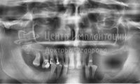 Восстановление зубов на обеих челюстях при пародонтозе - Фотография 3