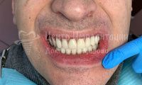 Множественный кариес зубов - Фотография 1