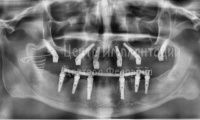 Восстановление зубов на двух челюстях при парадонтозе - Фотография 2