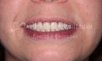 Восстановление зубов верхней и нижней челюсти - Фотография 4
