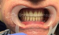 Восстановление зубов за два дня - Фотография 2