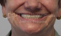 Восстановление зубов на верхней и нижней челюстях - Фотография 4