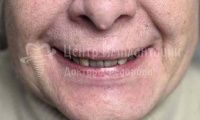 Имплантация на верхней и нижней челюсти - Фотография 2