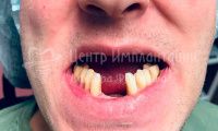 Имплантация зубов - Фотография 2