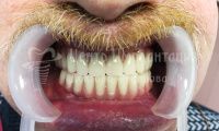 Полное восстановление всех зубов - Фотография 4