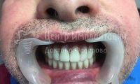 Восстановление зубов на обеих челюстях при парадонтозе - Фотография 4