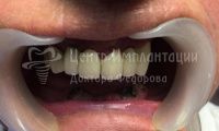Восстановление эстетики всех зубов - Фотография 3
