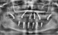 Восстановление зубов на обеих челюстях при парадонтозе - Фотография 2