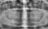 Полное восстановление всех зубов - Фотография 1