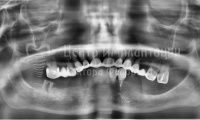 Восстановление зубов на нижней челюсти - Фотография 1